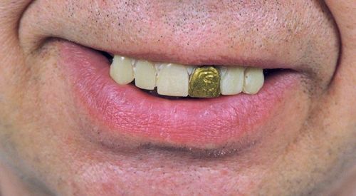 Teeth Glow Gold Miner Case Pack 2